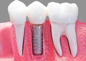 Foto article implant dentaire prix