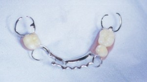Prothese dentaire stellite partielle