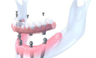 prothese dentaire transvissée