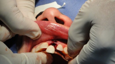 Mise en charge immédiate d'un implant dentaire